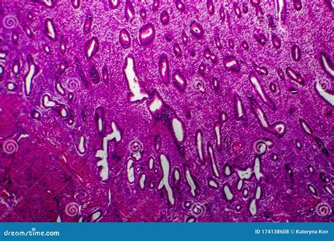 Endometrial Hyperplasia Light Micrograph Stock Photo Image Of