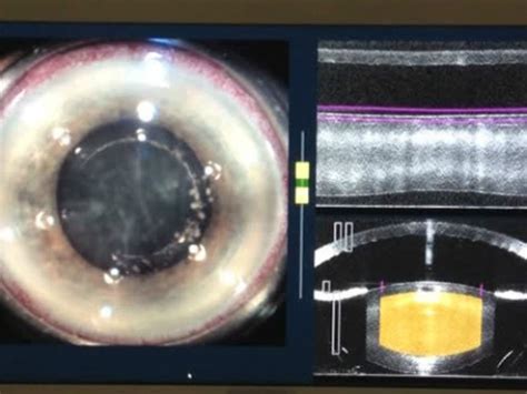 Chirurgie De Cataracte Paris Femtocataracte Phaco Mulsification