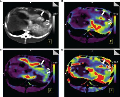 Frontiers Early Assessment Of Response To Radiofrequency Ablation