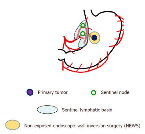 Schema Of Nonexposed Endoscopic Wall Inversion Surgery News With