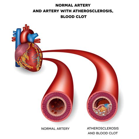 What Is Ldl Cholesterol Symptoms And Treatment Pulse Cardiology