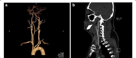 Carotid Artery Cta A 3d Reconstruction B 2d Slice Image Credits Download Scientific Diagram