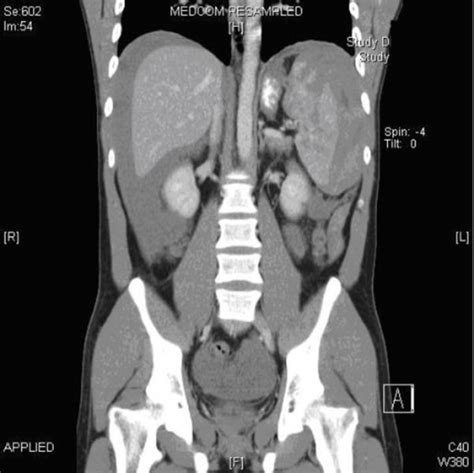 Coronal Section On Ct Abdomen Showing Haemoperitoneum A Open I