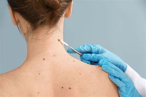 Skin Cancer Early Signs And Prevention Tips Connectdr