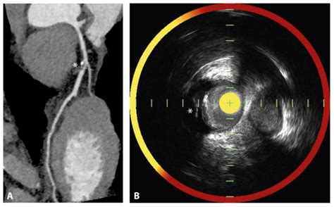 Vulnerable Plaque On CTCA A Displays The Left Anterior Descending