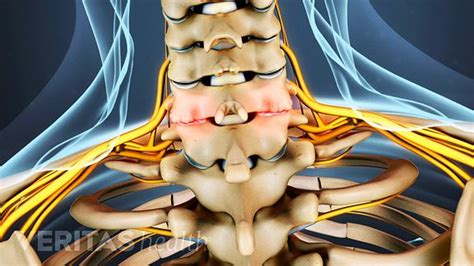 Cervical Osteoarthritis (Neck Arthritis)