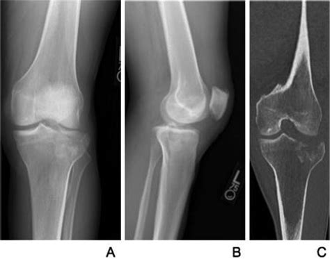 Anterior Tibial Plateau Fracture