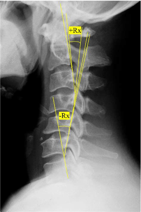 Figure 1 From Cervical Alignment And Clinical Outcome Of Anterior