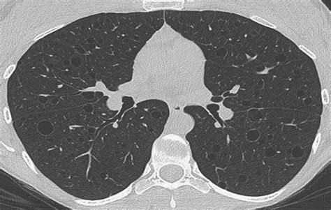 Pulmonary Insights Hrct Is Cost Effective In Screening For Diffuse