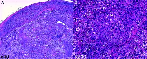 Haematoxylin And Eosin He Staining Of A Subcutaneous Tumour In The