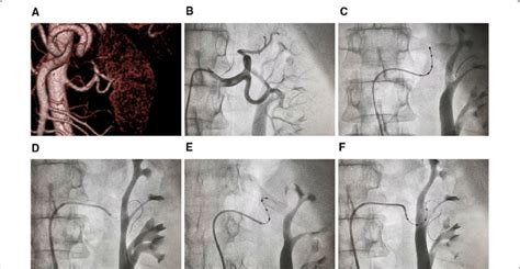 Angiography And Denervation Of The Left Renal Artery A Download Scientific Diagram