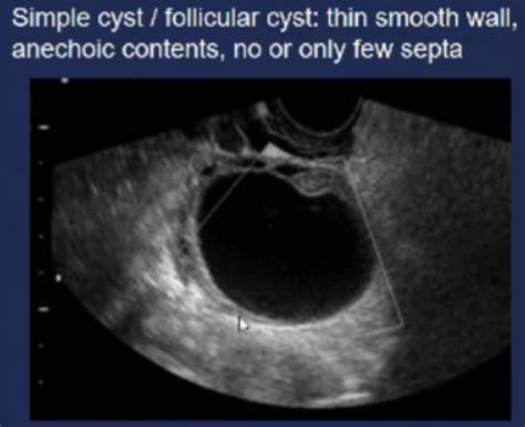 Ovarian Abnormalities Cysts Urr Flashcards Quizlet