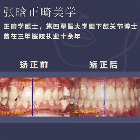 牙齿矫正：重度牙齿拥挤不拔牙可以矫正吗？矫正完会嘴凸吗？ 知乎