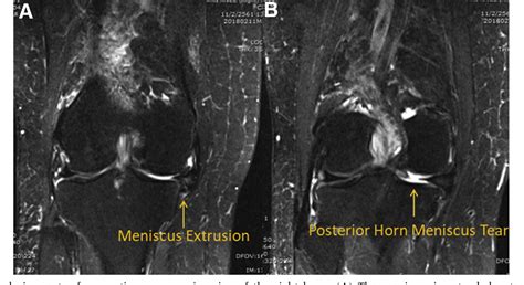 Arthroscopic All Inside Medial Meniscus Extrusion Reduction Semantic Scholar