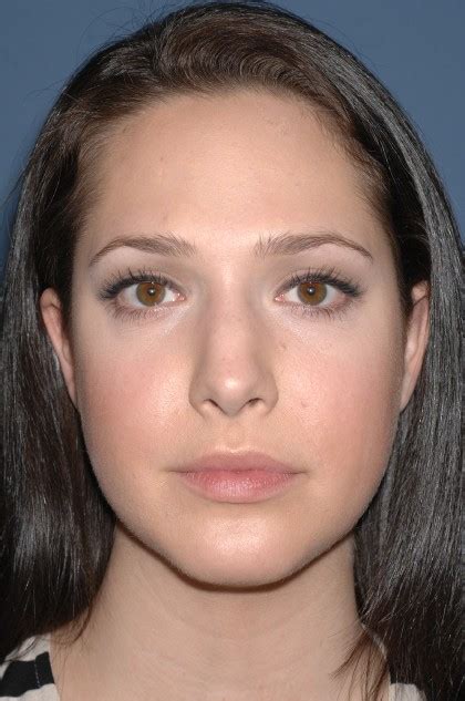 Patient 3872 Nose Surgery Rhinoplasty Primary Before And After