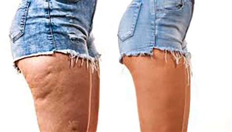 Cellulite Studio Di Nutrizione