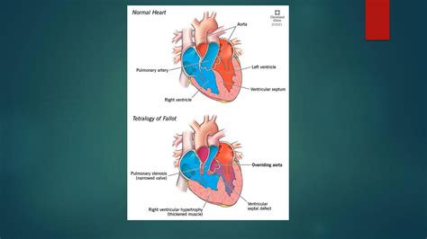 SOLUTION Tetralogy Of Fallot Studypool