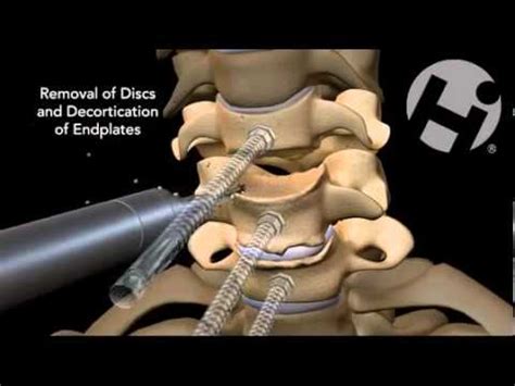 CERVICAL SURGERY C5-C6-C7 - YouTube