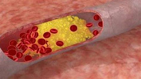 Kadar Lemak Dalam Darah Yang Terlalu Tinggi Bisa Sebabkan Komplikasi