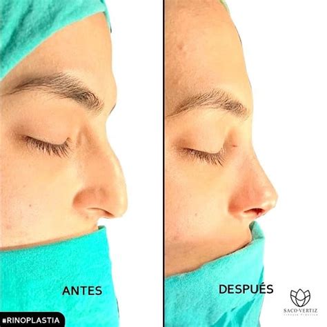 Rinoplastia Cerrada Cirugía Estética De La Nariz Surgery In Peru