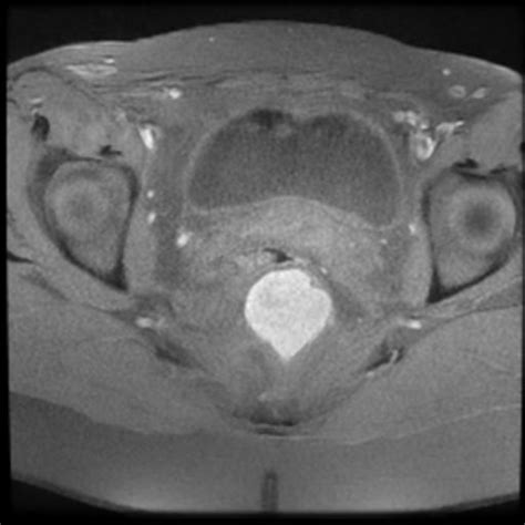 Tailgut Duplication Cyst Image Radiopaedia Org