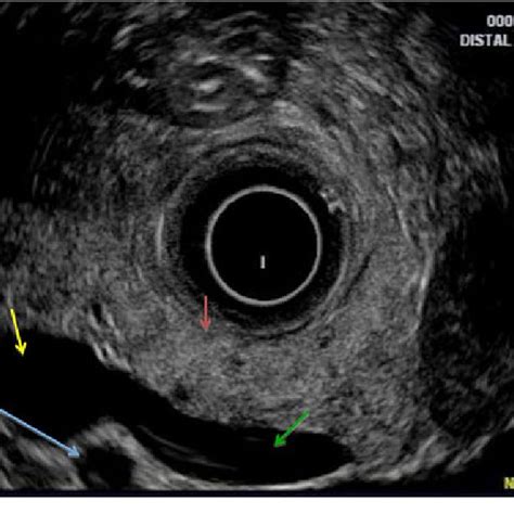 Normal Endoscopic Ultrasound Image Of The Pancreas Acquired With A Download Scientific Diagram