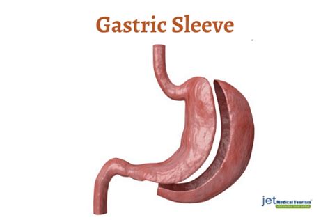 Gastric Sleeve Failure Can A Gastric Sleeve Be Redone