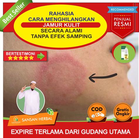 Salep Kulit Gatal Karena Jamur Salep Untuk Jamur Kulit Yang Bagus