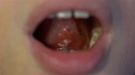 surgery stitches under tongue after oper... | Stock Video | Pond5