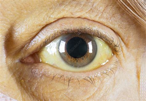 Kayser-Fleischer ring in eye due to liver disease - Stock Image - C046 ...