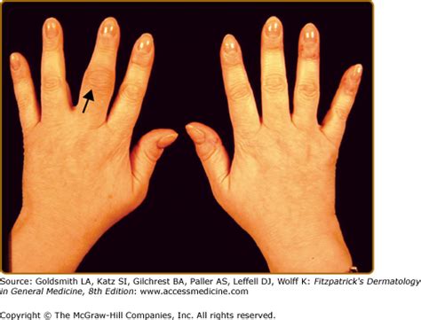 Psoriatic Arthritis | Plastic Surgery Key