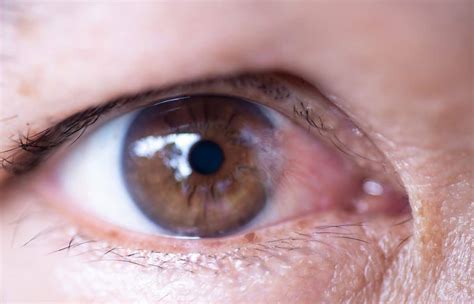 Ocular Surface Disease Cornea Cataract Consultants Of Arizona