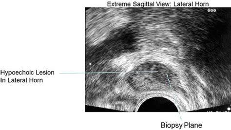 of Prostate Ultrasound for Prostate Biopsy | Oncohema Key