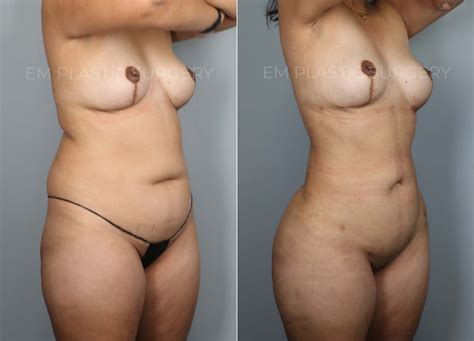 Liposuction Before After Photo Gallery Elise Min Plastic Surgery