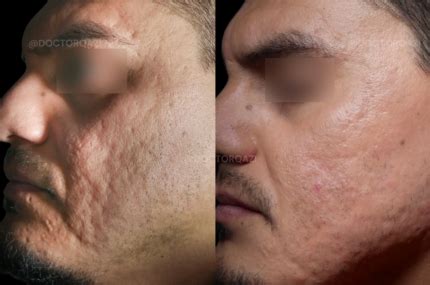 Microneedling For Acne Scars