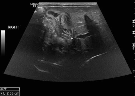 Pyloric Stenosis | Abdominal Key