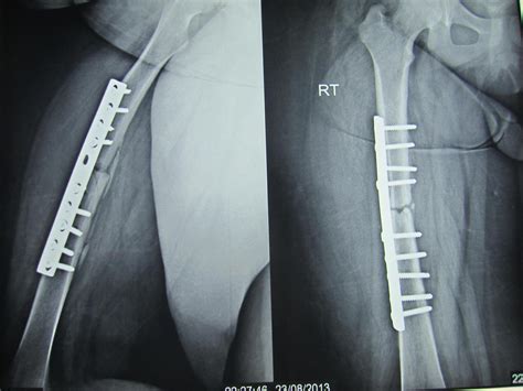 Femoral Shaft Fracture