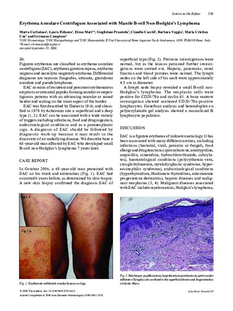 Erythema Annulare Centrifugum Histology