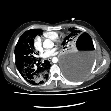 Loculated Pleural Effusion Ct Image Guided Drainage Of Intrathoracic