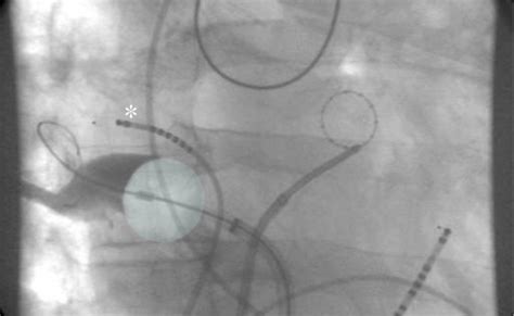 Cryoballoon Ablation How To Isolate Inferior Pulmonary Veins Otosection