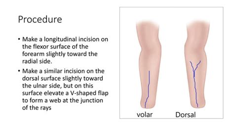 Krukenberg surgery | PPT