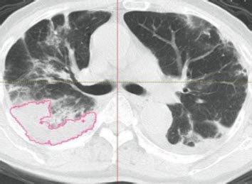 COVID-19 Lung Damage Measurement - AnalyzeDirect