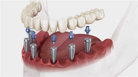 Tarifs Implant Dentaire En France Options De Financement