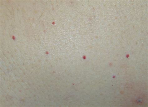 How To Treat Dots Bumps And Red Spots On Skin Skin Spots Dots Red Dots