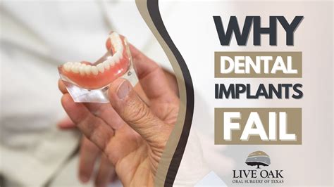 Why Dental Implants Fail Youtube