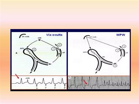 Sindrome De Wolff Parkinson White Ppt