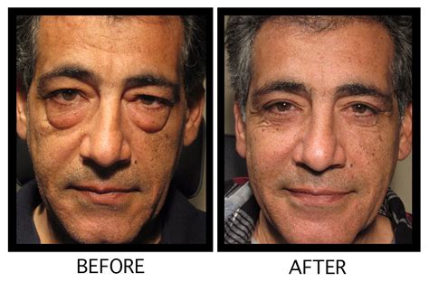 Celebrity Blepharoplasty Before And After