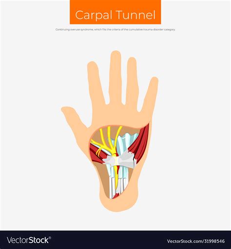 Carpal Tunnel Royalty Free Vector Image VectorStock