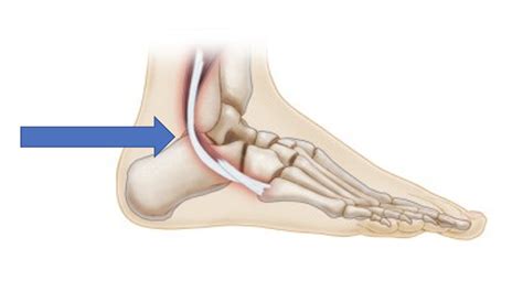 Peroneal Tendon Tear Foot And Ankle Injuries Dr Justin Dean