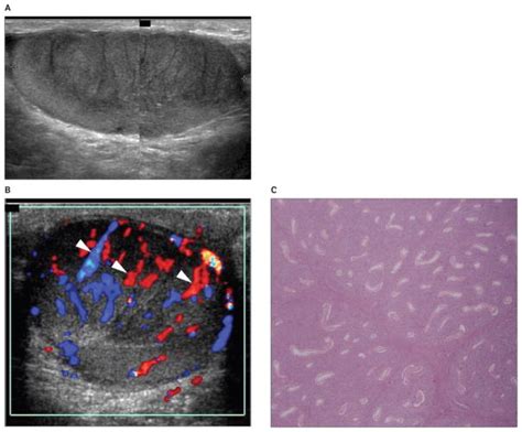 Grayscale And Color Doppler Features Of Testicular Lymphoma PMC